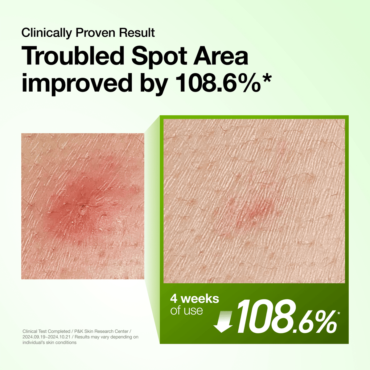 Anua US Ampoule/Serum Azelaic Acid 10 Hyaluron Redness Soothing Serum